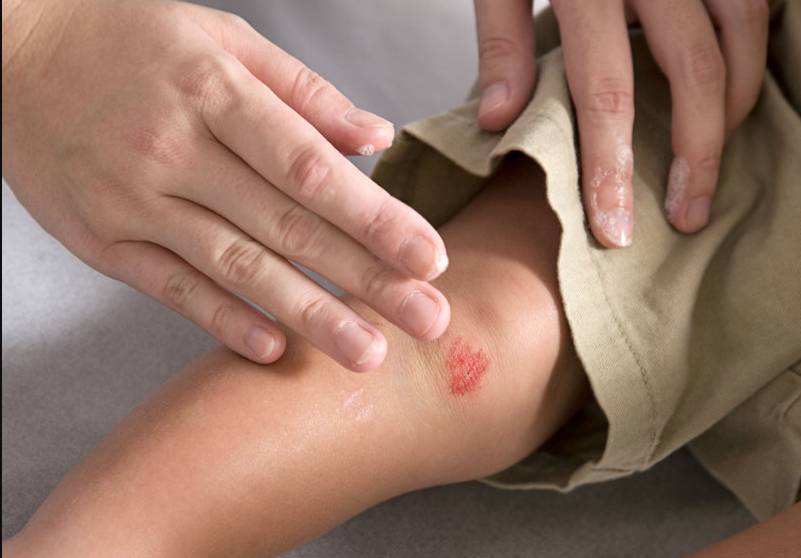 ¡Cuidado con las heridas! ¿Cuántas heridas hemos sufrido a lo largo de nuestra vida? Si no es un corte, es un arañazo o un rasguño, pero lo cierto es que nuestra piel debe lidiar constantemente con este tipo de lesiones, que, en la mayoría de las ocasiones, son leves y no suponen mayor problema.