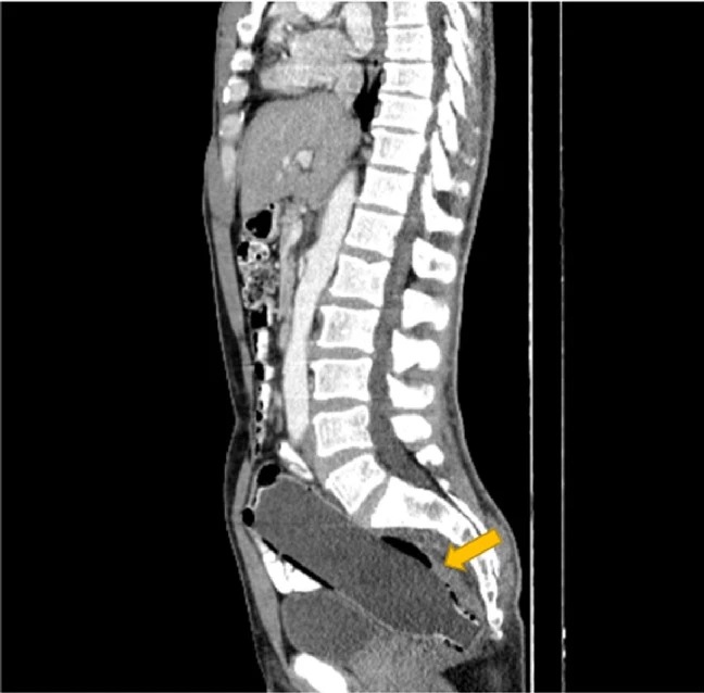 Fue al médico por dolor en el estómago y le encontraron una botella en el recto 1 Fue al médico por dolor en el estómago y le encontraron una botella en el recto Según un artículo de la Clínica Case Reports Journal, el hombre evitó mencionar que él mismo había insertado una botella plástica por el recto, debido a la "vergüenza" y al "miedo a su esposa".