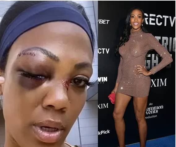 Medallista olímpica fue brutalmente golpeada en la cara por un habitante de calle 1 Medallista olímpica fue brutalmente golpeada en la cara por un habitante de calle La exjugadora y medallista olímpica de voleibol estadounidense Kim Glass fue brutalmente atacada por un habitante de calle con un tubo de metal.