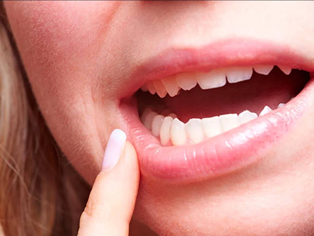 Molestas y dolorosas, úlceras bucales Hay diferentes tipos de úlceras bucales y pueden aparecer en cualquier parte dentro de la boca, incluso el fondo de la boca, la parte interna de las mejillas, las encías, los labios y la lengua.