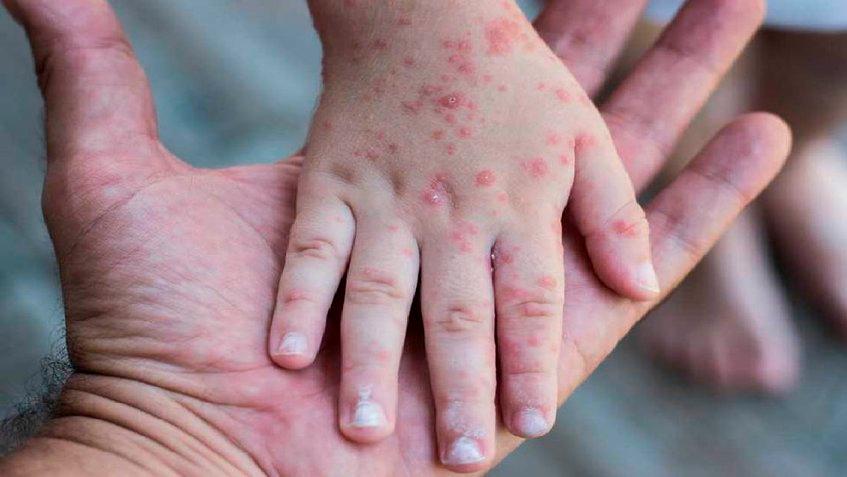 OMS cambia el nombre de la viruela del mono por 'Mpox' para evitar lenguaje racista 2 OMS cambia el nombre de la viruela del mono por 'Mpox' para evitar lenguaje racista La Organización Mundial de la Salud (OMS) ha anunciado el cambio de nombre de la viruela del mono, que a partir de ahora se denominará 'mpox' como abreviación del nombre original en inglés (monkeypox), con el objetivo de evitar el "lenguaje racista y estigmatizante".