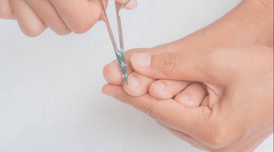 Los dolorosos uñeros Habitualmente se localiza alrededor de las uñas, en su unión con la piel. Se producen pequeñas heridas en el ángulo de la piel que cubre la base de la uña, normalmente por alguna deficiencia a la hora de cortarla.