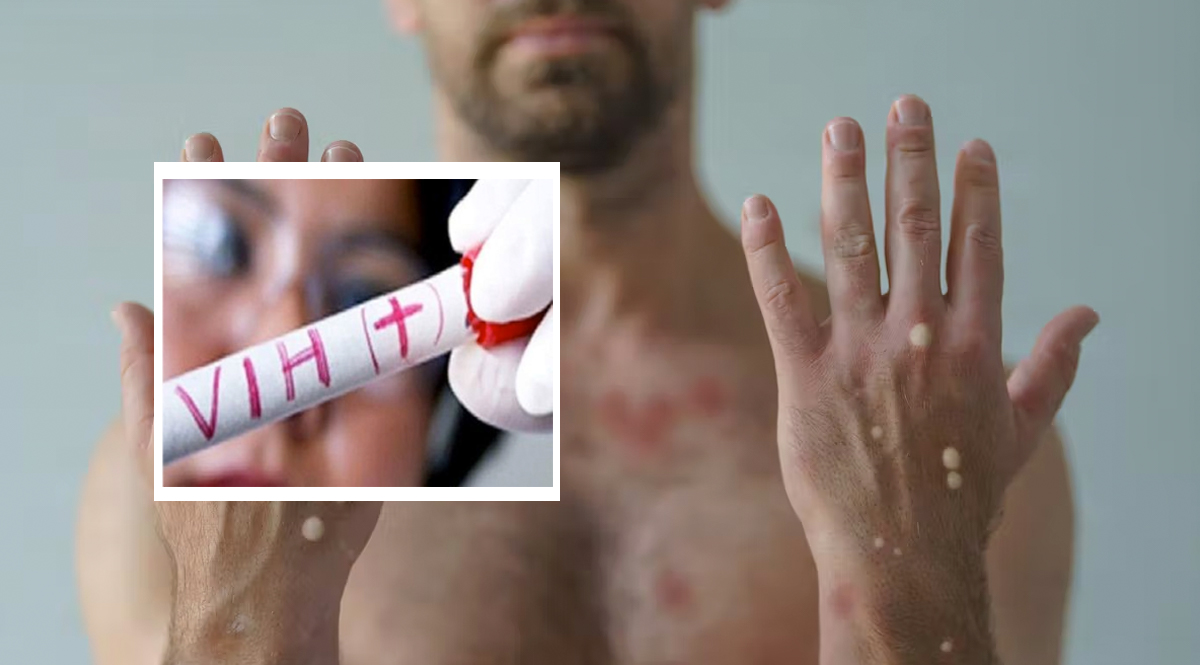 Turista que viajó a España se contagió de viruela del mono, Covid-19 y VIH al tiempo El hombre de 36 años proveniente de Italia, se le detectó tres virus mortales, Covid-19, viruela del mono y VIH. Según declaraciones fue porque no usó protección al momento de tener relaciones sexuales cuando viajó a España.