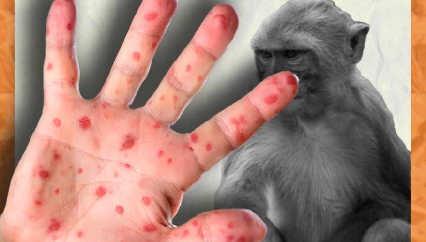 Casos confirmado de viruela del mono siguen creciendo en Colombia El Instituto Nacional de Salud (INS) confirmó que el país alcanzó los 2.042 casos confirmados de la viruela símica, también conocida como la viruela del mono, presentando un incremento frente a los datos reportados una semana atrás (1.653).