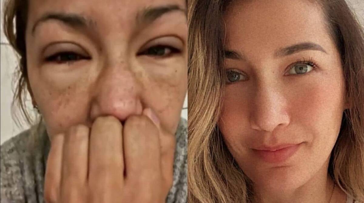 Un transplante les dio una segunda oportunidad 1 Un transplante les dio una segunda oportunidad Una insuficiencia renal se convirtió en una pesadilla para la bella presentadora de RCN Adriana Betancur. La bella modelo paisa, que hoy tiene 42 años, tuvo una intervención para recibir un riñón en 2014, pero a mediados de 2021 la presentadora apareció en sus redes sociales con su cara hinchada, la razón: su cuerpo rechazó el transplante, haciendo que se le acumularan 10 kilos de toxinas. Hoy en día se encuentra mejor gracias a la asistencia médica, pero está a la espera de una nueva donación.