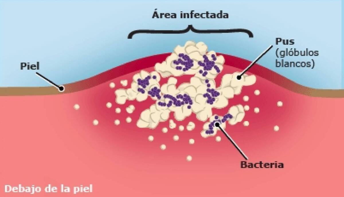 Póngale cuidado a los abscesos de la piel Los abscesos cutáneos son comunes y afectan a personas de todas las edades. Se presentan cuando una infección provoca la acumulación de pus en la piel.