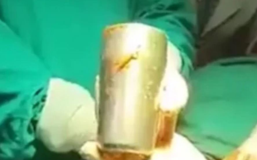 Médicos le sacaron vaso de acero a hombre que tenía fuerte dolor de estómago 1 Médicos le sacaron vaso de acero a hombre que tenía fuerte dolor de estómago Un hombre presentaba un extraño y fuerte dolor de estómago luego de una noche de tragos. Al principio creyó que se trataba solo de un malestar normal, pero cuando la incomodidad continuó y ningún remedio le hacía efecto, decidió ir al médico.