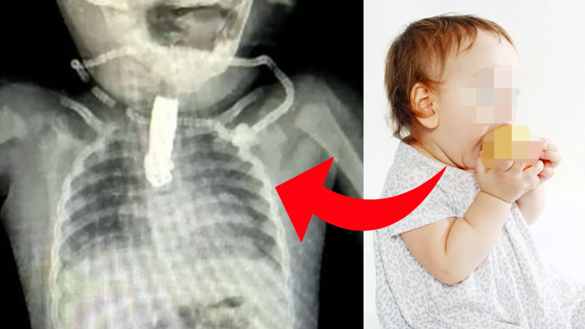 Bebé estuvo al borde de la muerte tras comerse un cortaúñas Una bebé de tan solo ocho meses estuvo al borde de la muerte luego de atragantarse con un cortaúñas con el que estaba jugando. La niña se salvó de puro milagro.