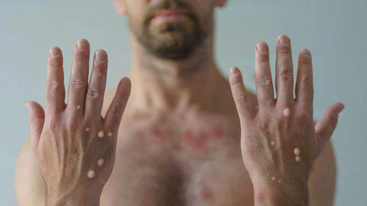 OMS cambia el nombre de la viruela del mono por 'Mpox' para evitar lenguaje racista 1 OMS cambia el nombre de la viruela del mono por 'Mpox' para evitar lenguaje racista La Organización Mundial de la Salud (OMS) ha anunciado el cambio de nombre de la viruela del mono, que a partir de ahora se denominará 'mpox' como abreviación del nombre original en inglés (monkeypox), con el objetivo de evitar el "lenguaje racista y estigmatizante".