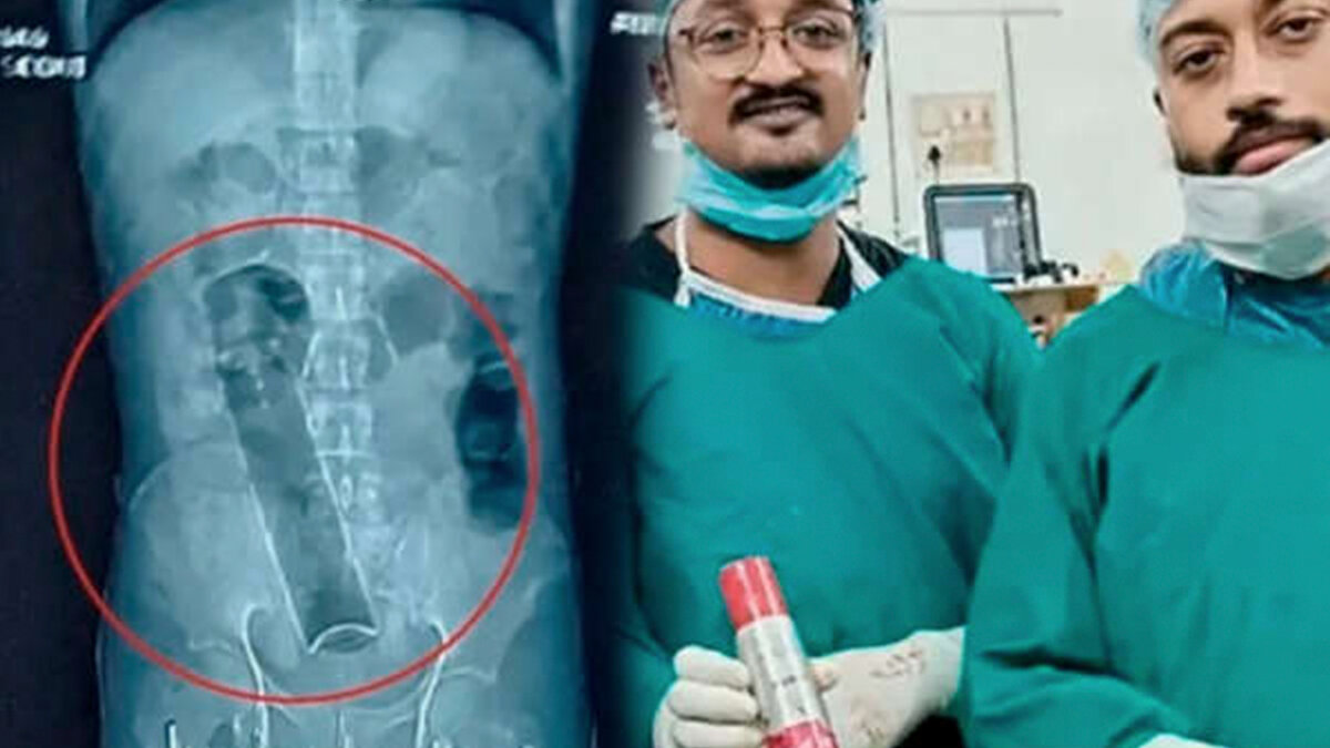 Impactante: médicos le encontraron un frasco de desodorante en el colon a un joven 4 Impactante: médicos le encontraron un frasco de desodorante en el colon a un joven Tras la cirugía, los médicos indicaron que tenía una lata de desodorante de aproximadamente 20 centímetros en el colón y que el paciente la habría introducido por su recto.