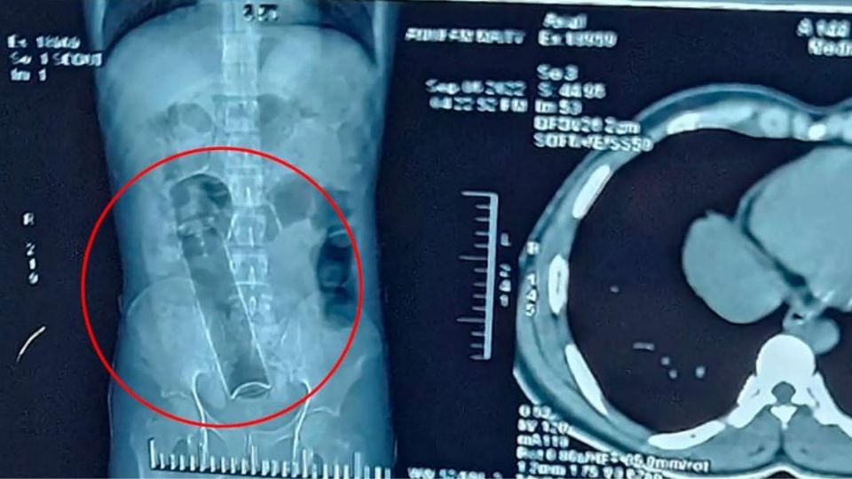 Impactante: médicos le encontraron un frasco de desodorante en el colon a un joven 1 Impactante: médicos le encontraron un frasco de desodorante en el colon a un joven Tras la cirugía, los médicos indicaron que tenía una lata de desodorante de aproximadamente 20 centímetros en el colón y que el paciente la habría introducido por su recto.