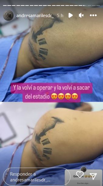 Yina Calderón ya se operó la cola, su madre reveló detalles 1 Yina Calderón ya se operó la cola, su madre reveló detalles Vuelve y juega con Yina Calderón. Ahora ella volvió a operarse, esta vez para mejorar el aspecto de sus glúteos caídos y continuar con su plan de ser toda una Barbie humana, como lo ha expresado varias veces.