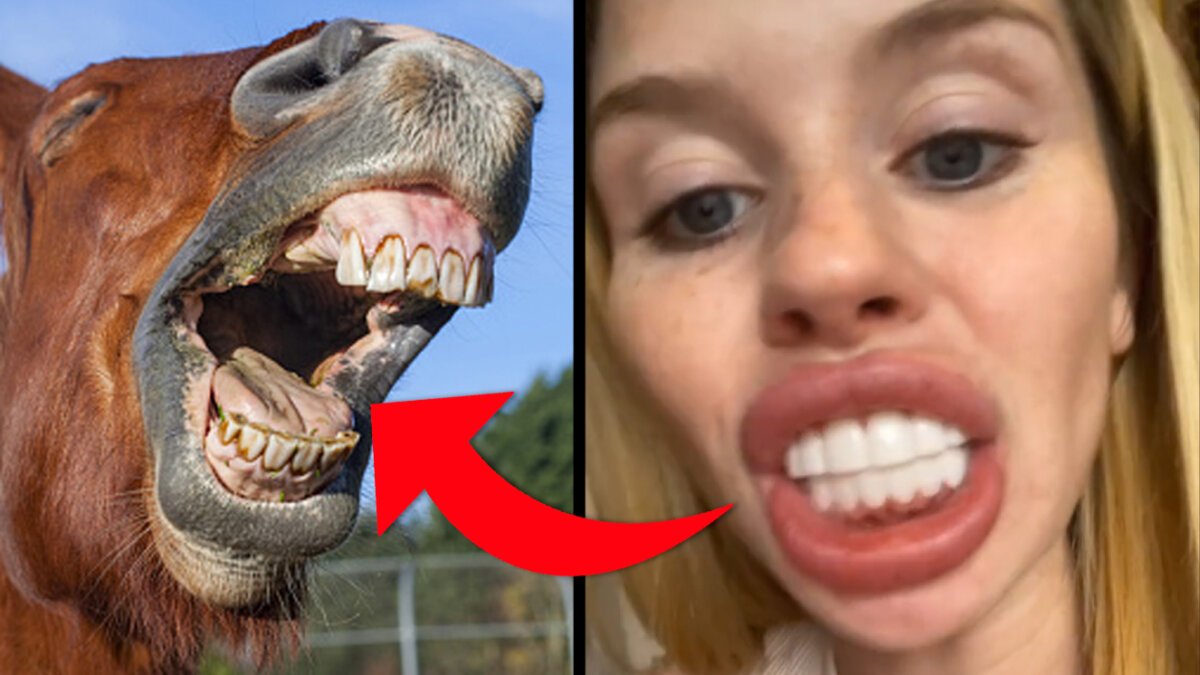 Mujer se hace diseño de sonrisa y la dejan "como un caballo" Por ahí dicen que lo barato sale caro, y eso lo experimentó en carne propia una mujer llamada Lauren Hartley, de 23 años, quien vio una promoción para realizarse un diseño de sonrisa, pero el resultado fue desastroso.