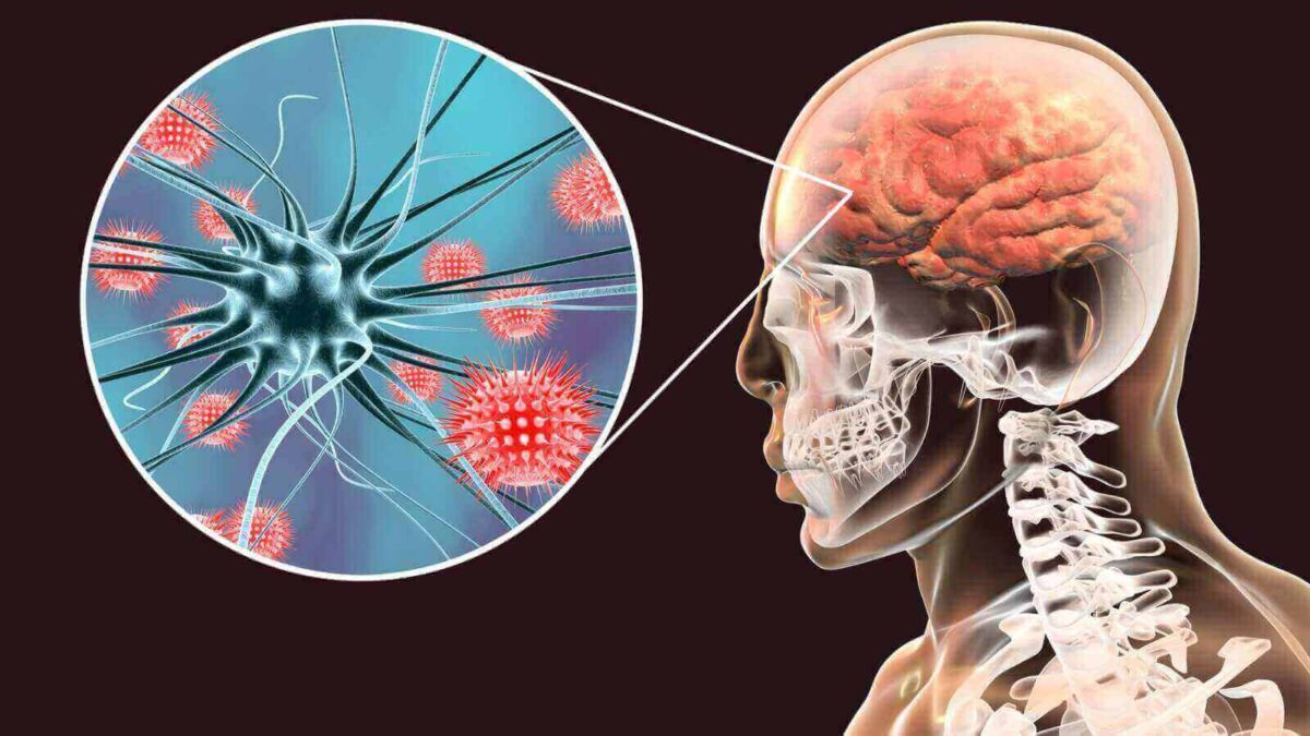 Va pa' arriba la meningitis 1 Va pa' arriba la meningitis Aumentaron en un 75 % los casos notificados de colombianos con meningitis, en comparación con el año anterior. Así lo dio a conocer el Instituto Nacional de Salud (INS), luego de realizar un análisis correspondiente al período epidemiológico VII (que corresponde a enero - julio del 2022), en el que se confirma que, de 626 casos notificados, 166 personas resultaron diagnosticadas con dicha enfermedad, de las cuales 30 perdieron la vida.