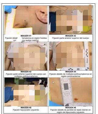 Revelan impactantes fotografías del cadáver de Juan Pablo González Juan Pablo González, señalado de abusar de una menor de edad en TransMilenio, recibió una brutal golpiza en las celdas de la URI Puente Aranda, la cual quedó plasmada en su piel.
