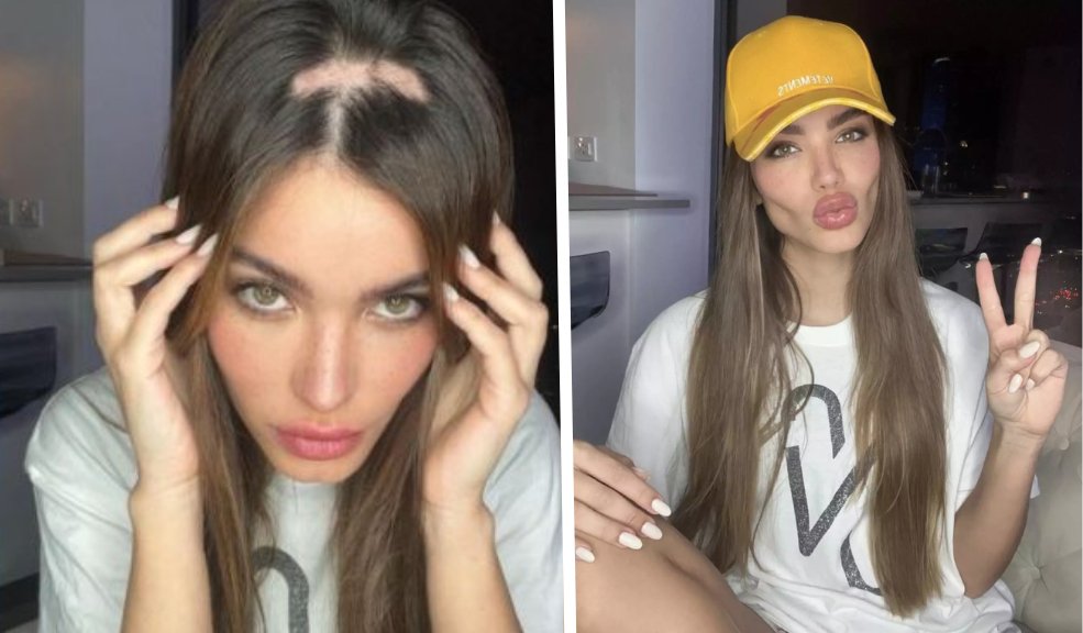 La mujer que le hizo brujería a Nicky Jam se le está cayendo el pelo 1 La mujer que le hizo brujería a Nicky Jam se le está cayendo el pelo Aleska Génesis, la ex del cantante Nicky Jam, reveló impresionantes imágenes de la grave alopecia que está sufriendo.