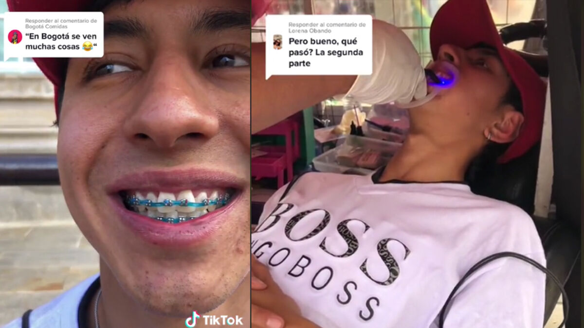 Insólito: así son los brackets de $100 mil que colocan en el centro de Bogotá Regresó el dentista del centro: jóvenes decidieron vivir en carne propia lo que es hacerse un procedimiento estético dental en la plaza de la mariposa, pleno centro de Bogotá, a un muy bajo costo.