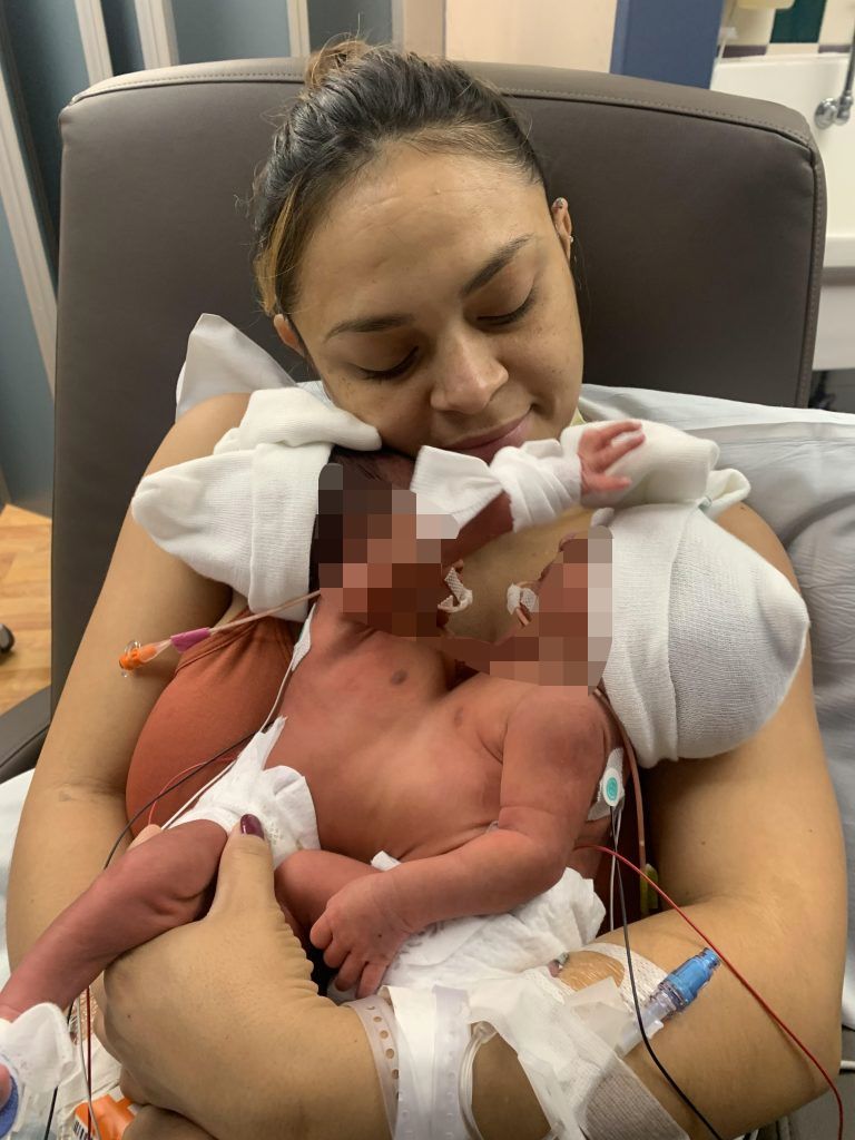 Separan a bebés siamesas que nacieron unidas por el tronco Una&nbsp;increíble hazaña&nbsp;lograron los médicos de un&nbsp;hospital en Texas, en Estados Unidos, tras&nbsp;separar a un par de bebés siamesas.&nbsp;