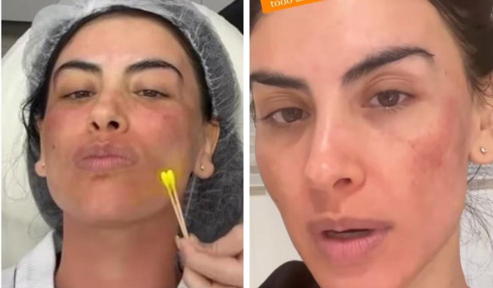 Por un tratamiento, Jessica Cediel tuvo tremendo cambio en su rostro 7 Por un tratamiento, Jessica Cediel tuvo tremendo cambio en su rostro Esta vez, Jessica Cediel compartió la evolución de su rostro luego de un tratamiento. El video sorprendió a los internautas!