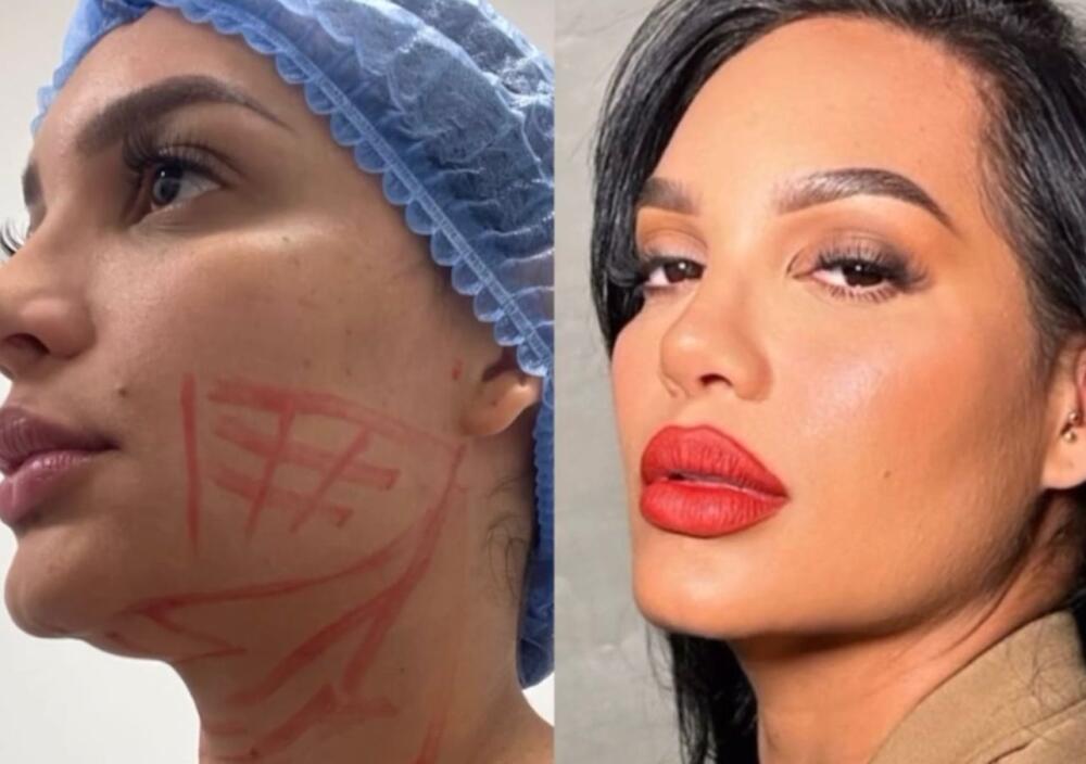La Valdiri se realizó una cirugía estética para quitarse un 'gordito' del rostro 1 La Valdiri se realizó una cirugía estética para quitarse un 'gordito' del rostro En las últimas horas, Andrea Valdiri dejó ver a sus seguidores a través de Instagram, la cirugía que se hizo en su cara, al parecer, porque tenía un 'gordito' que no se le quitaba con nada.