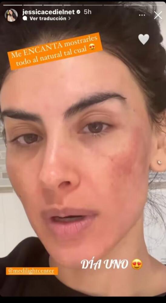 Por un tratamiento, Jessica Cediel tuvo tremendo cambio en su rostro 1 Por un tratamiento, Jessica Cediel tuvo tremendo cambio en su rostro Esta vez, Jessica Cediel compartió la evolución de su rostro luego de un tratamiento. El video sorprendió a los internautas!