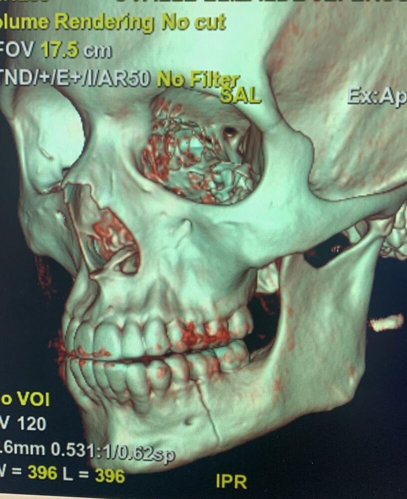 Denuncian brutal agresión en medio de partido de fútbol en Kennedy 2 Denuncian brutal agresión en medio de partido de fútbol en Kennedy Jefferson Ovalle, un joven abogado de 28 años se encuentra en estos momentos en un centro médico a la espera de una cirugía en su mandíbula tras haber sido agredido en un partido de fútbol por uno de los integrantes del equipo rival, en Kennedy.
