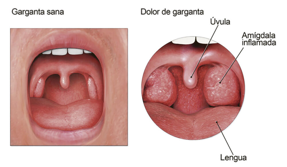 El fastidioso dolor de garganta El ‘fastidio’ en la garganta es dolor, carraspera o irritación de la garganta que a menudo empeora al tragar. La causa más frecuente de la también llamada faringitis es una infección viral, como un resfrío o la gripa.