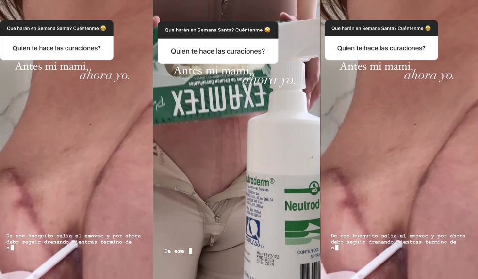 Lina Tejeiro mostró cómo le quedó la cola por los biopolímeros La reconocida actriz Lina Tejeiro nunca ha ocultado las consecuencias que ha tenido en su cuerpo luego de haberse inyectado biopolímeros hace algunos años, los cuales le estaban generando bastantes problemas de salud, por lo que tuvo que someterse a dos cirugías para extraerlos.