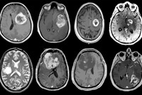 Inteligencia artificial predice la genética de tumores cerebrales Un equipo de neurocirujanos e ingenieros de varias universidades estadounidenses ha desarrollado un sistema de diagnóstico basado en inteligencia artificial (IA) que utiliza imágenes rápidas para analizar muestras tumorales tomadas durante una operación y detectar mutaciones genéticas en menos de 90 segundos.