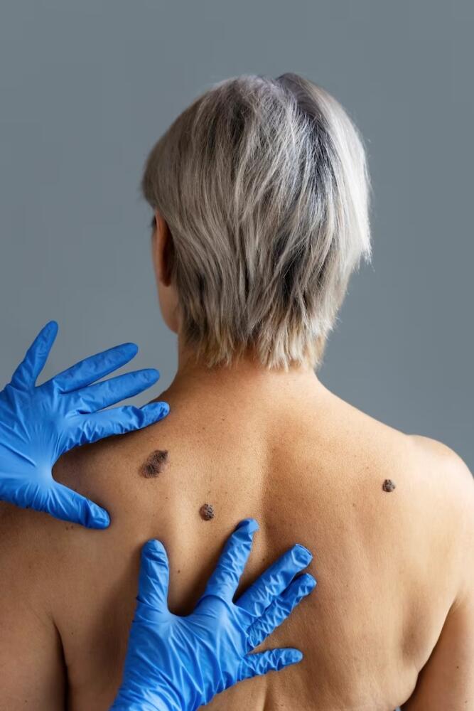 Gánele la carrera al cáncer de piel El objetivo de tener un día para conmemorar la lucha contra el cáncer de piel es recordarles a las personas lo importante que es el cuidado de la piel, en especial porque existen medidas de prevención y hay una tasa de recuperación alta en caso de ser detectado a tiempo. 