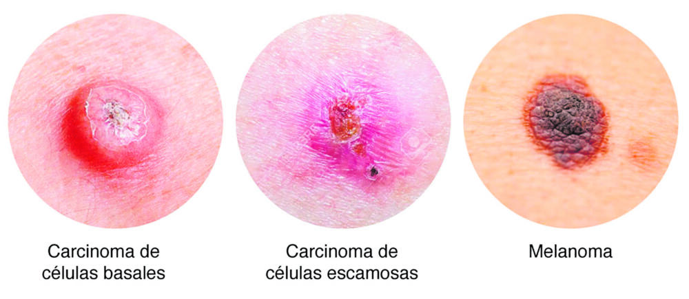 Gánele la carrera al cáncer de piel El objetivo de tener un día para conmemorar la lucha contra el cáncer de piel es recordarles a las personas lo importante que es el cuidado de la piel, en especial porque existen medidas de prevención y hay una tasa de recuperación alta en caso de ser detectado a tiempo. 