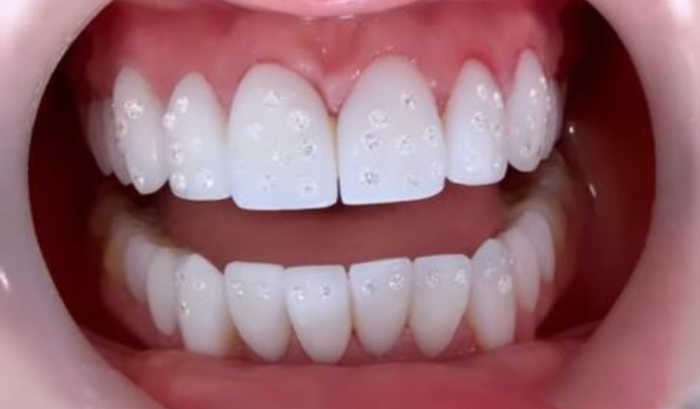 ¡De no creer! 'Epa Colombia' apareció con 80 diamantes en sus dientes 1 ¡De no creer! 'Epa Colombia' apareció con 80 diamantes en sus dientes 'Epa Colombia' sorprendió con gran cantidad de diamantes en sus dientes.