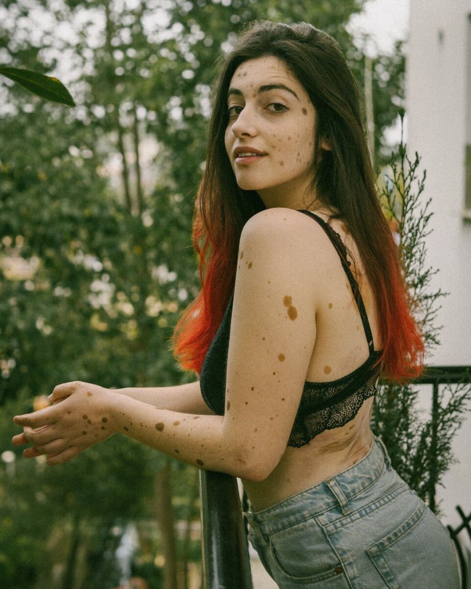 Conozca a la mujer con mil lunares que se volvió modelo 1 Conozca a la mujer con mil lunares que se volvió modelo