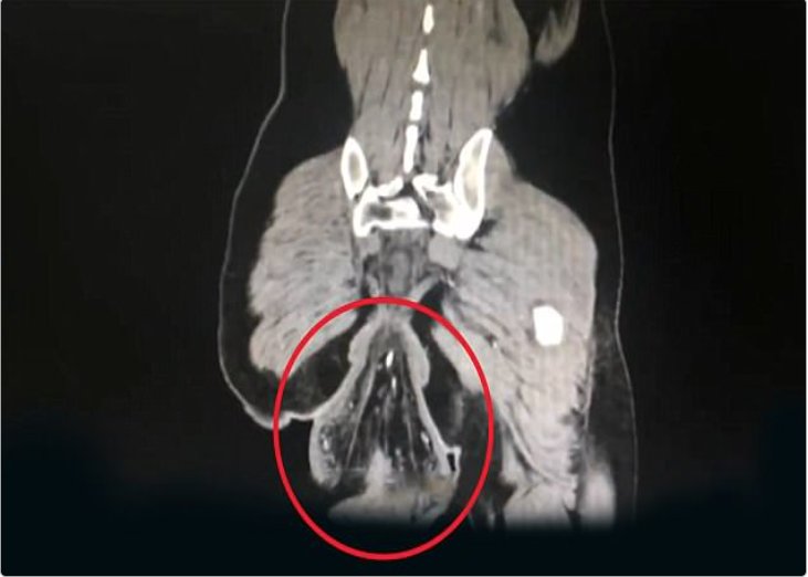 A un hombre se le salió el intestino por pasar mucho tiempo en el inodoro jugando con el celular 1 A un hombre se le salió el intestino por pasar mucho tiempo en el inodoro jugando con el celular El caso ocurrió en el sureste de la provincia de Guangdong, en China, y el afectado tuvo que acudir a la medianoche a un hospital.