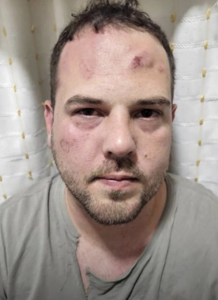 La brutal golpiza que habría recibido John Poulos en La Picota 2 La brutal golpiza que habría recibido John Poulos en La Picota En redes anda circulando una foto en la cual aparece John Poulos con varias heridas y golpes en su rostro, producto de una golpiza que habría recibido al interior de La Picota.