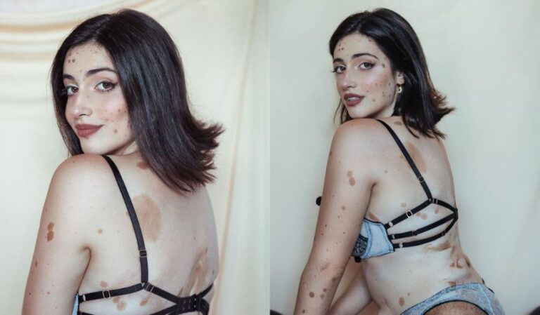 Conozca a la mujer con mil lunares que se volvió modelo