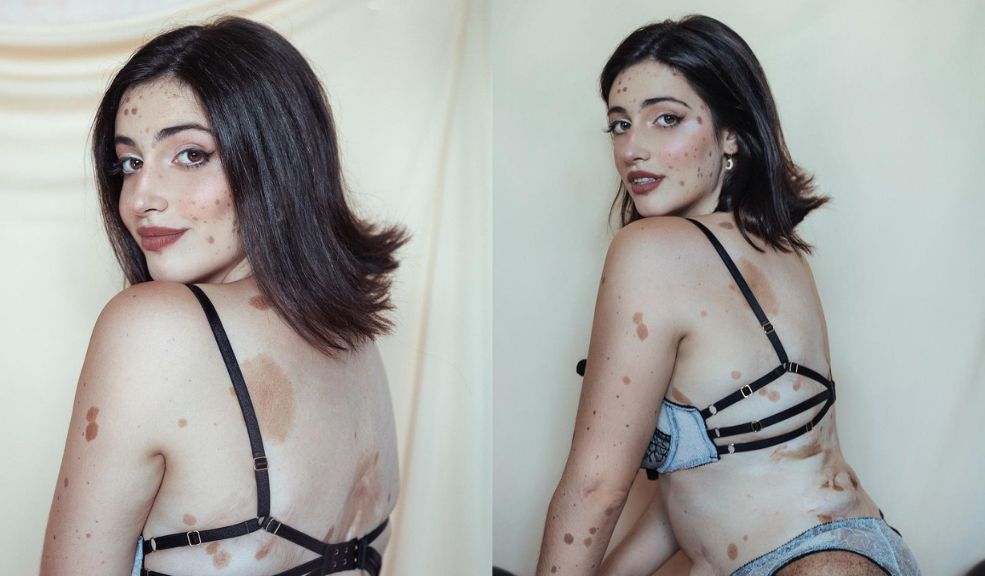 Conozca a la mujer con mil lunares que se volvió modelo 4 Conozca a la mujer con mil lunares que se volvió modelo