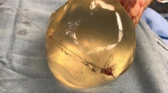 Mujer se salvó de la muerte gracias a sus prótesis de silicona Una mujer que se encontraba caminando recibió un disparo que al parecer iba dirigido al corazón, pero gracias a sus prótesis de silicona se salvó.