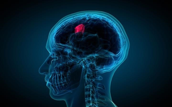 83% de las personas no sospecha tener cáncer antes del diagnóstico Es importante una atención integral y un adecuado manejo del cáncer.