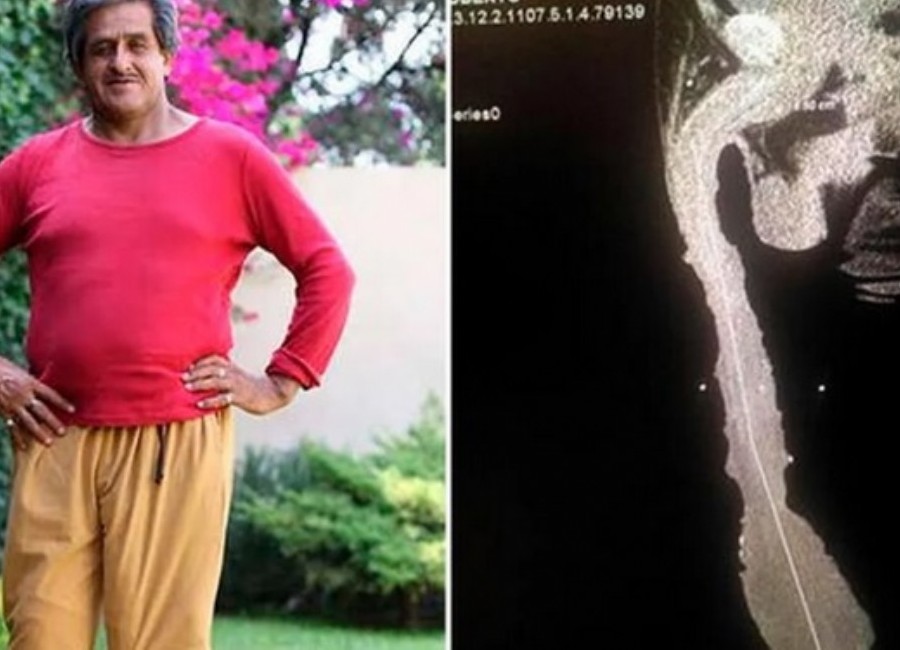 El hombre con el pene más grande del mundo nunca ha tenido novia Su salud está deteriorada por su enorme miembro viril y ha tenido varias complicaciones, como no poder tener relaciones sexuales