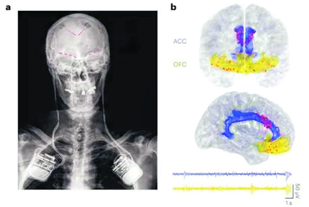 Por implante cerebral pudo volver a moverse Un hombre suizo de 46 años se convirtió en la primera persona en usar una tecnología que combina dos implantes, uno va al cerebro y el otro a la médula espinal, esto con el objetivo de recuperar el movimiento de las extremidades superiores, lo que implica brazos, manos y dedos, todo a través del pensamiento. En Q’HUBO le contamos cómo fue el procedimiento y cómo funciona. 