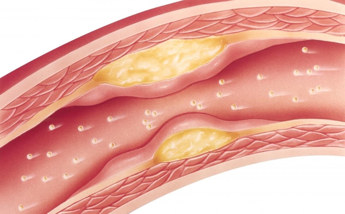 Aprenda a cuidar sus niveles de colesterol Aunque el colesterol es esencial para diversas funciones corporales, un exceso de LDL o “colesterol malo” puede acumularse en las arterias, formando placas que obstaculizan el flujo sanguíneo y aumentan el riesgo de enfermedades cardíacas.