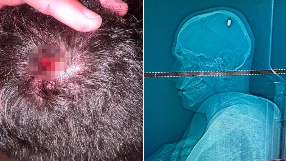 Joven se fue de fiesta por cuatro días sin saber que tenía una bala en la cabeza En Brasil, el joven Mateus Facio estuvo de fiestas y terminó en cuidados intensivos por una bala en su cabeza.