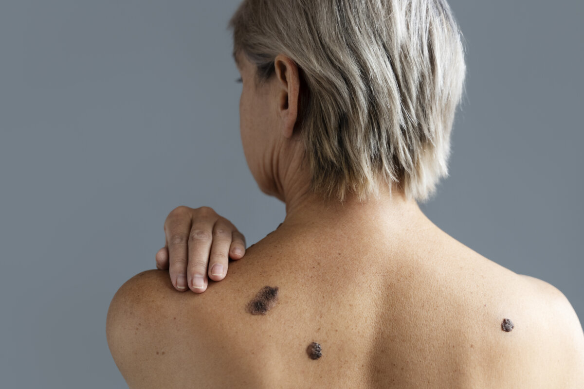 ¡Aprenda a proteger su piel! 1 ¡Aprenda a proteger su piel! La incidencia del cáncer de piel, incluido el melanoma, ha experimentado un notable aumento en los últimos años. Según un estudio, se estima que para el año 2040 el melanoma será el segundo tumor más frecuente a nivel mundial.