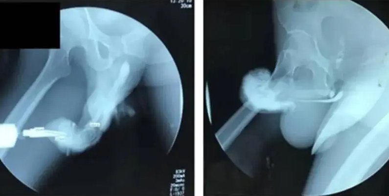 Cantante se fracturó el miembro durante encuentro íntimo 1 Cantante se fracturó el miembro durante encuentro íntimo El hombre explicó cómo ocurrió la fractura.