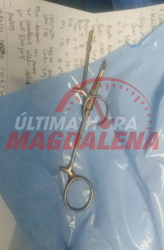 Hallan tijeras en abdomen de una joven tras cirugía: se debate entre la vida y la muerte 1 Hallan tijeras en abdomen de una joven tras cirugía: se debate entre la vida y la muerte El objeto, que fue dejado durante una cirugía que realizada en Barranquilla, destruyó el intestino y parte del colon.