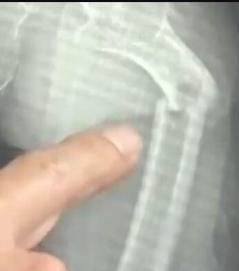 ¡Insólito! Se rompió el fémur después de una tos por beber mucha Coca Cola 1 ¡Insólito! Se rompió el fémur después de una tos por beber mucha Coca Cola Un hombre de 35 años de la ciudad china de Fuzhou se partió en dos el fémur, el hueso más duro del cuerpo humano, tras toser violentamente, según informaron los medios locales.