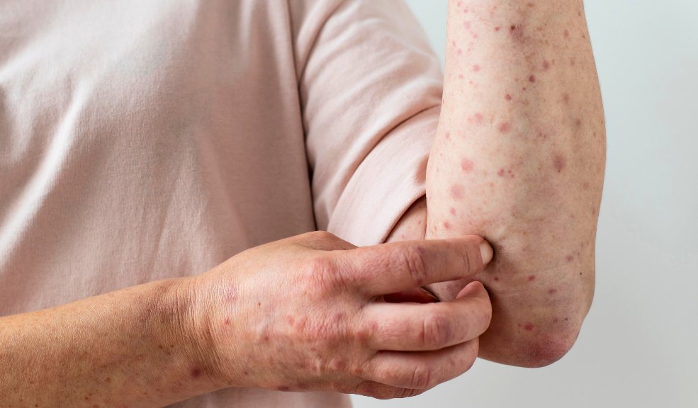 Consejos para prevenir las alergias en la vida diaria Entre el 20% y el 25% de la población mundial sufre de algún tipo de alergia, una realidad que subraya la importancia de la Semana de la Alergia, una iniciativa destinada a invitar a las personas a tomar conciencia sobre estas afecciones y su impacto en la vida cotidiana.