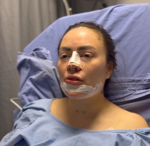 Tres nuevos "arreglitos" estéticos han puesto en riesgo la salud de Epa Colombia 1 Tres nuevos "arreglitos" estéticos han puesto en riesgo la salud de Epa Colombia Daneidy Barrera, conocida popularmente como Epa Colombia, atraviesa complicaciones de salud luego de someterse a tres cirugías estéticas. A través de sus redes sociales, Epa Colombia documentó todo el proceso, desde los preparativos antes de la cirugía hasta los difíciles momentos de recuperación.
