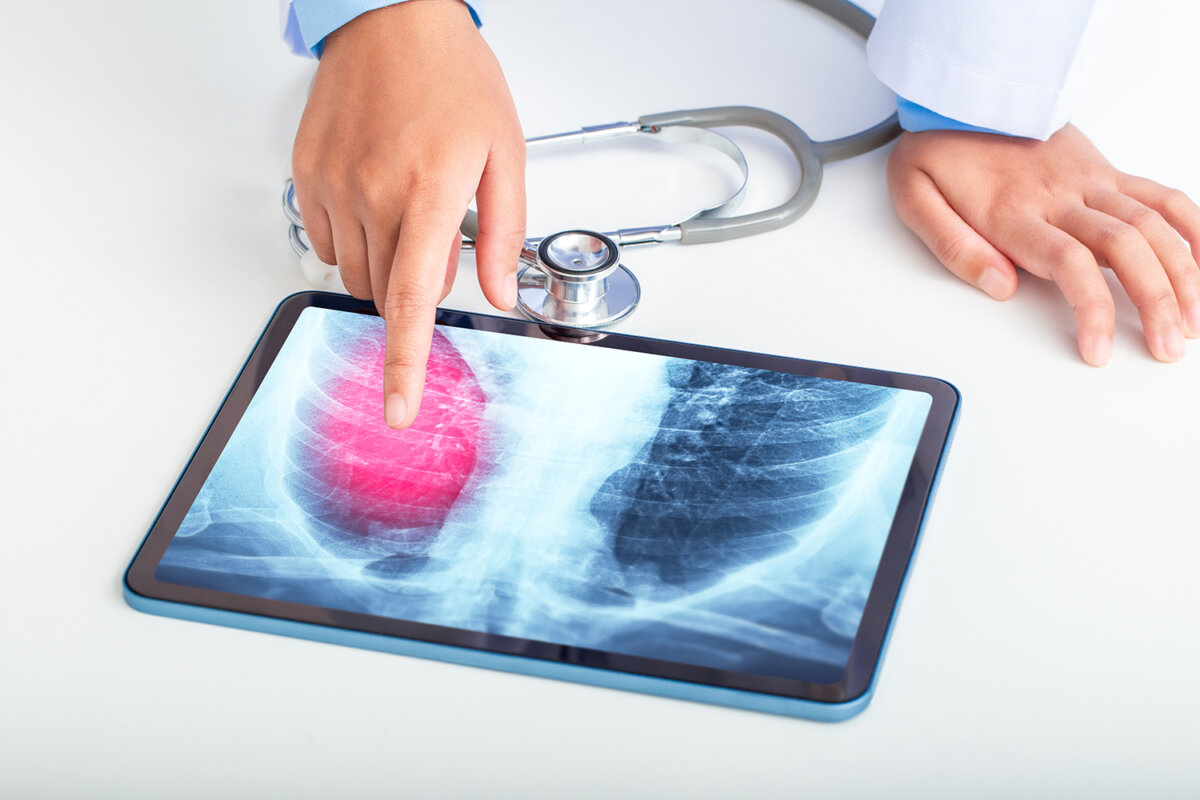 Cáncer de pulmón: una enfermedad silenciosa que cobra miles de vidas en Colombia y el mundo Aunque su vínculo con el consumo de tabaco es bien conocido, también afecta a personas que nunca han fumado.